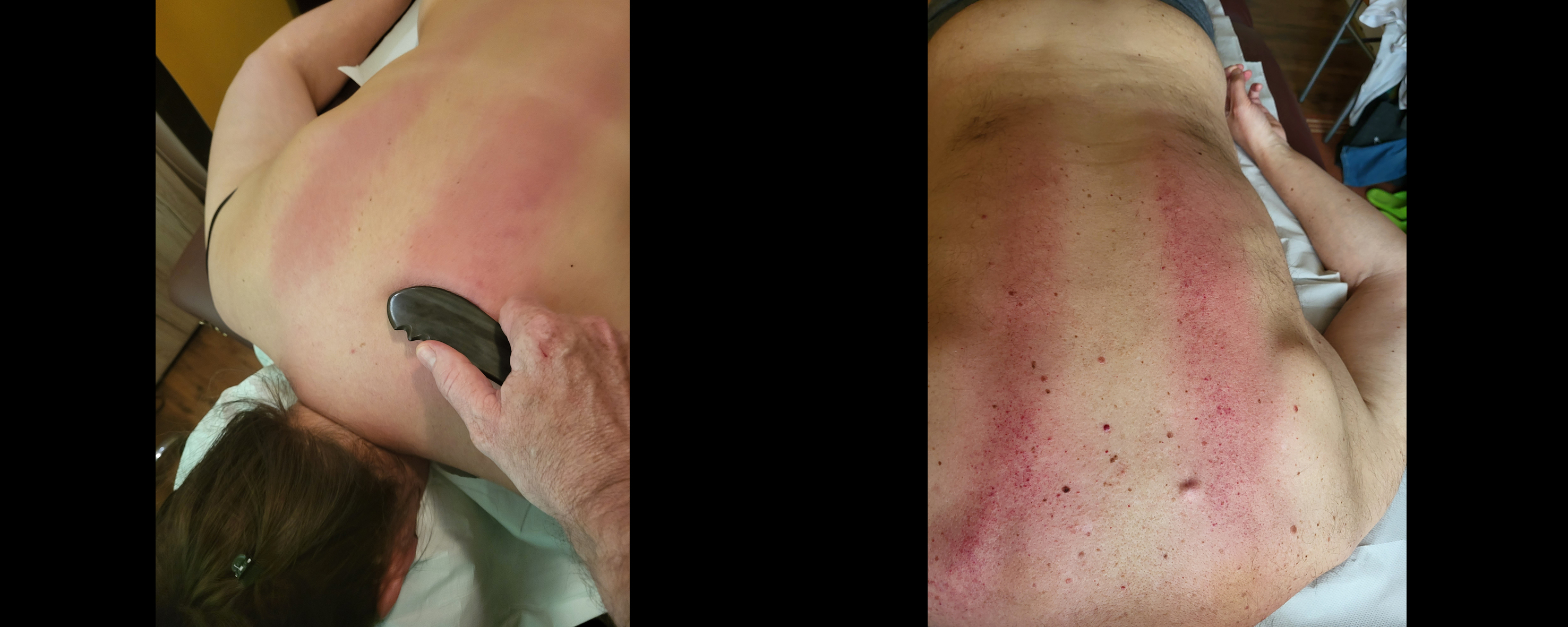 Gua Sha Massage